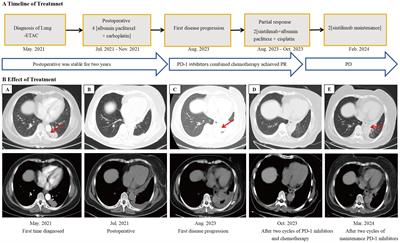 Lung enteric-type adenocarcinoma with gastric metastasis: a rare case report and literature review